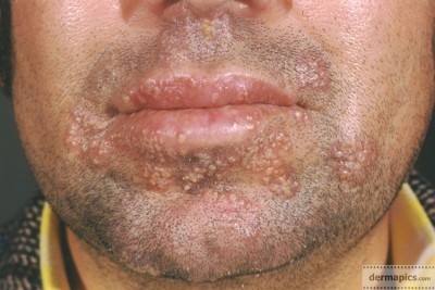 eheheherpes-lips-b1.jpg